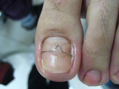 Лечение вросшего ногтя без операции