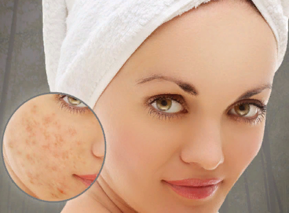 Какие маски для лица от прыщей самые эффективные маски для лица от прыщей фото