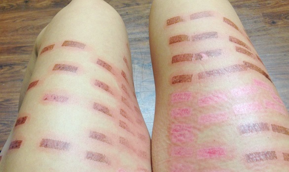 Ожог после эпиляции: ходите только к проверенным специалистам!