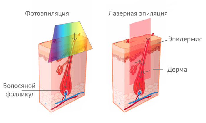 Фотоэпиляция и лазерная эпиляция. Что лучше?