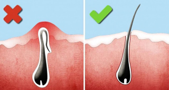 Почему после эпиляции появляются вросшие волоски и как с ними бороться