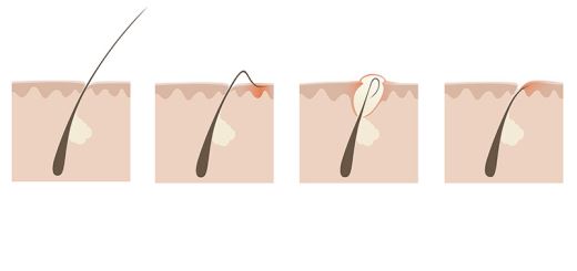 Почему после эпиляции появляются вросшие волоски и как с ними бороться