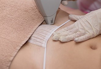 лазерная эпиляция бикини1