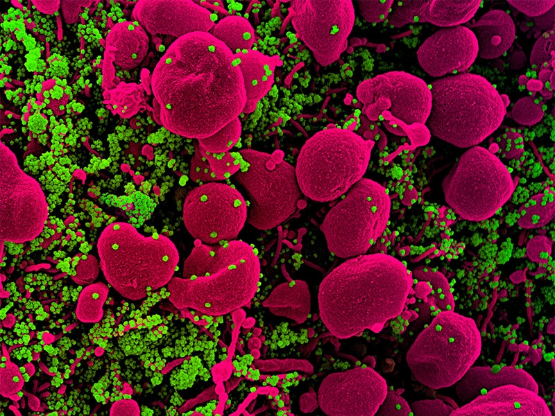 Число умерших от COVID-19 в мире превысило 400 тыс.