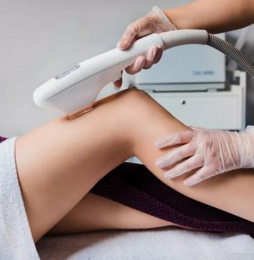 Лазерная эпиляция