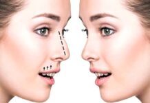 Ринопластика: показания