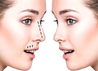 Ринопластика: показания