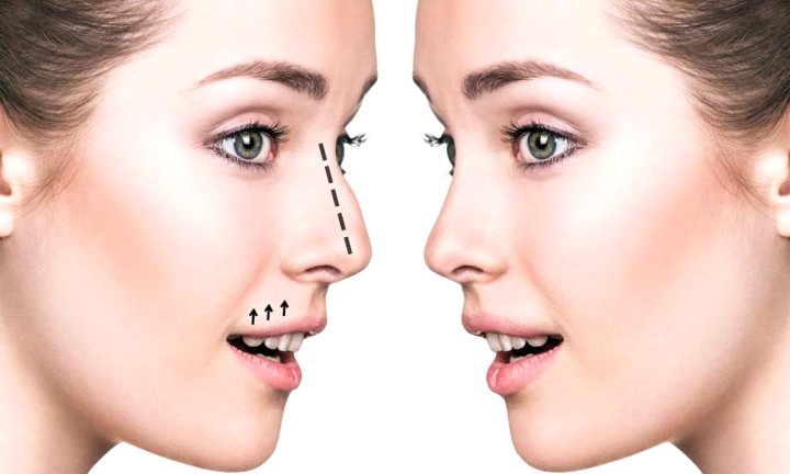 Ринопластика: показания