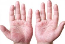 Экзема и дерматит, чем отличаются, симптомы.