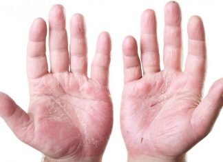 Экзема и дерматит, чем отличаются, симптомы.