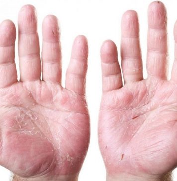 Экзема и дерматит, чем отличаются, симптомы.