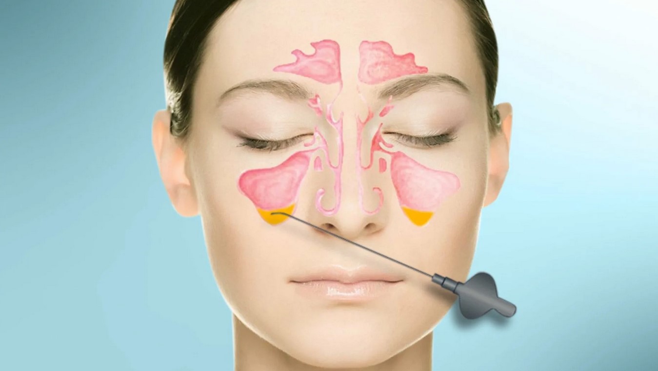 Гайморит: причины, симптомы и лечение