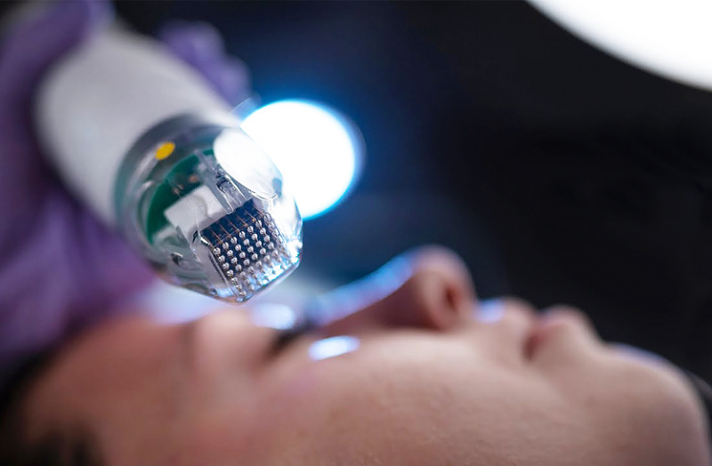 Игольчатый RF-лифтинг: что это такое и особенности процедуры