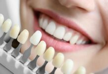 Что такое виниры и как она ставятся