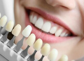 Что такое виниры и как она ставятся