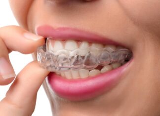 Почему стоит выбрать элайнеры: современный подход к исправлению прикуса