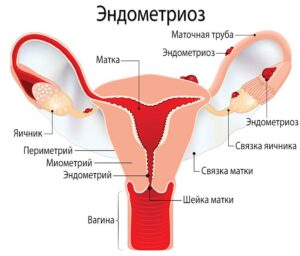 Эндометриоз: симптомы и лечение