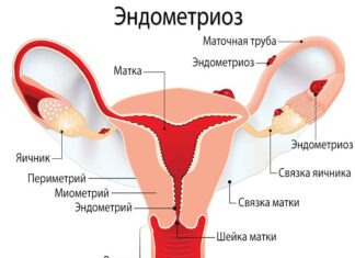 Эндометриоз: симптомы и лечение