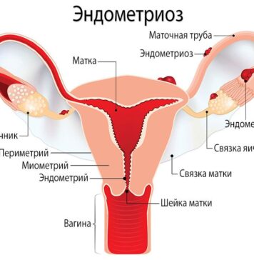 Эндометриоз: симптомы и лечение