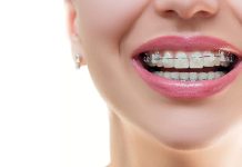 Инновационная система брекетов Damon Clear: комфорт и эффективность для идеальной улыбки без видимых брекетов