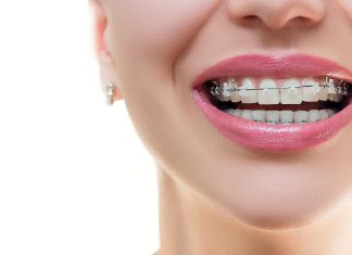 Инновационная система брекетов Damon Clear: комфорт и эффективность для идеальной улыбки без видимых брекетов