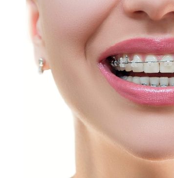 Инновационная система брекетов Damon Clear: комфорт и эффективность для идеальной улыбки без видимых брекетов