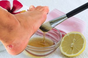 Виды мозолей: как подолог определяет тип перед удалением