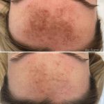 Процедура BBL: Революция в Эстетической Медицины