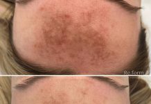 Процедура BBL: Революция в Эстетической Медицины