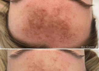 Процедура BBL: Революция в Эстетической Медицины