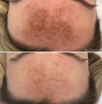 Процедура BBL: Революция в Эстетической Медицины