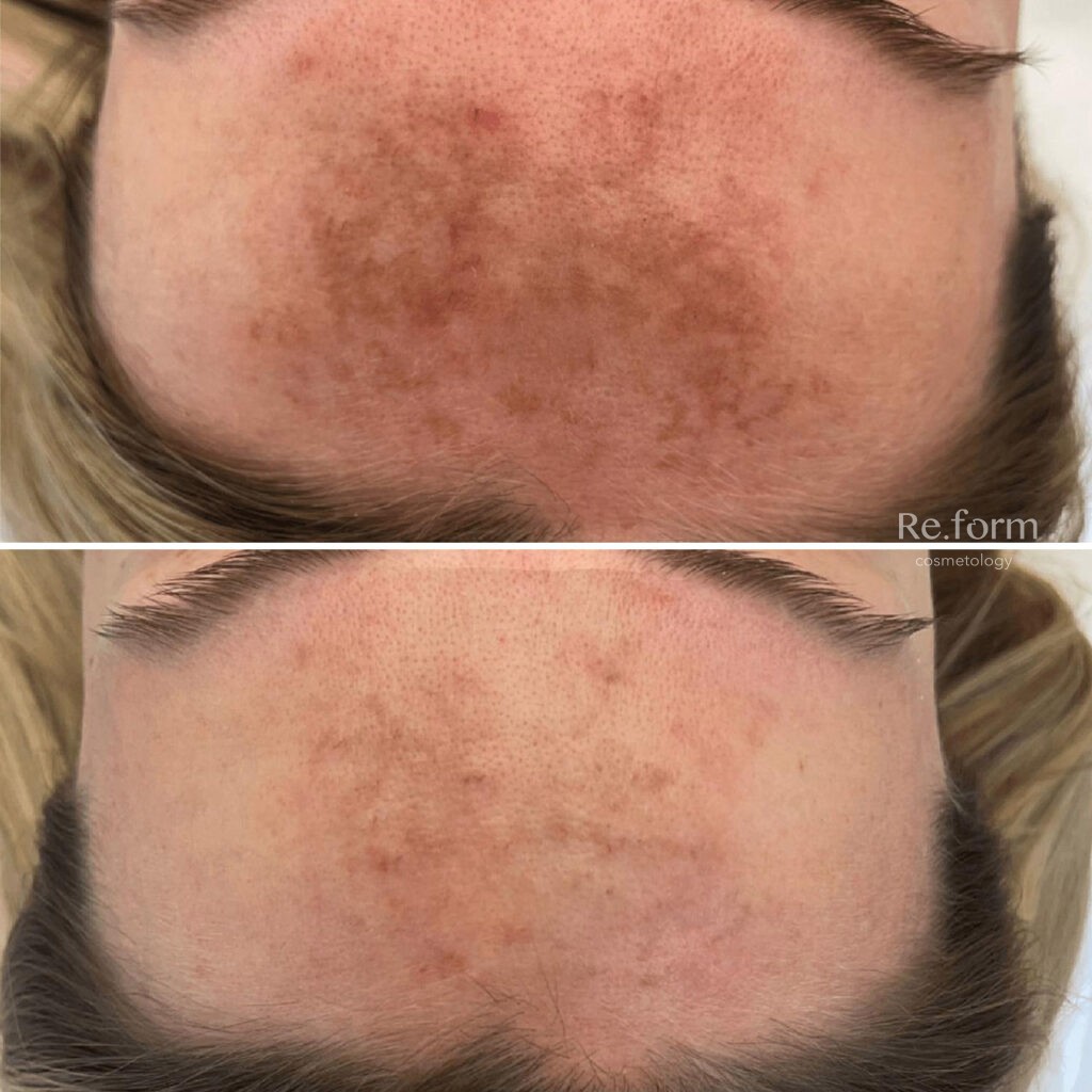 Процедура BBL: Революция в Эстетической Медицины