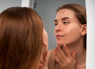 Причины акне: гормоны, бактерии и питание