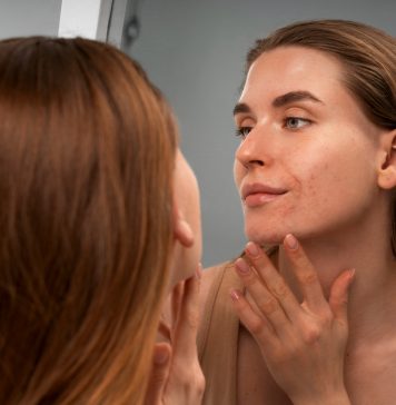 Причины акне: гормоны, бактерии и питание